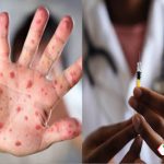 EE.UU. ofrecerá vacunas contra la viruela del mono a casos sospechosos